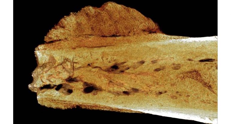 Encuentran el primer cáncer humano en un hueso de 1.7 millones de años